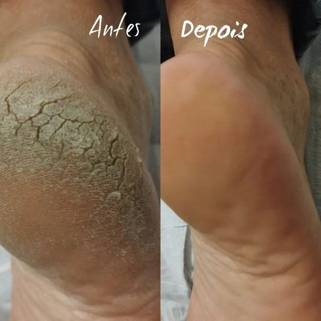 Creme milagroso para os pés  - Foto 4