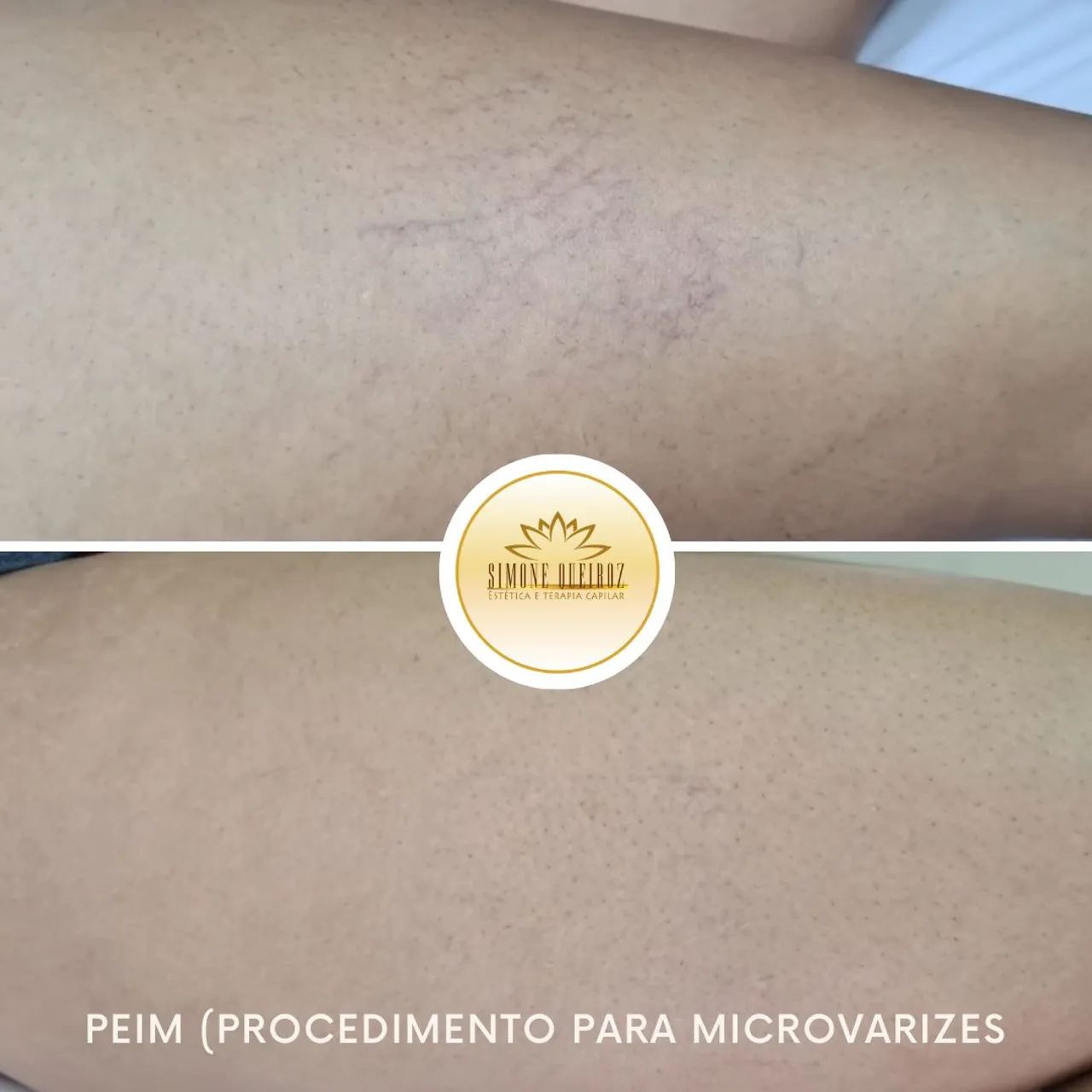 Tratamento para microvarizes  - Foto 3