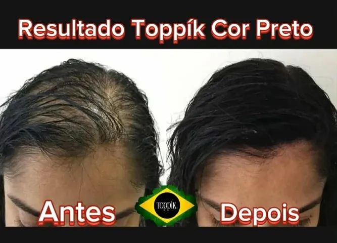 Queda de Cabelo - Foto 2