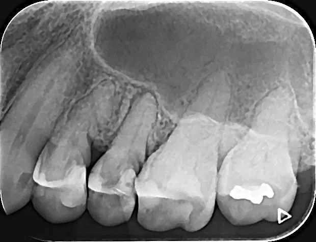 Sensor Dental Intraoral - Novo! - Foto 4