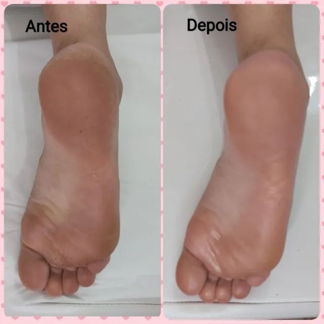 Plástica dos Pés - Foto 2
