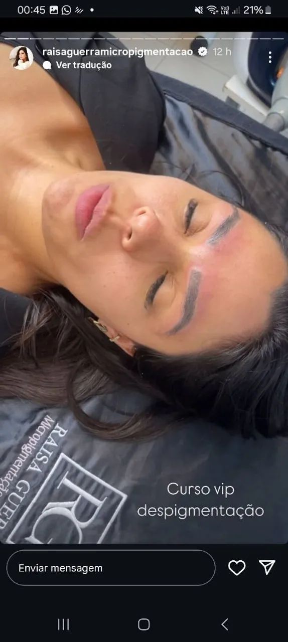 Remoção de tatuagem a lazer - Foto 3