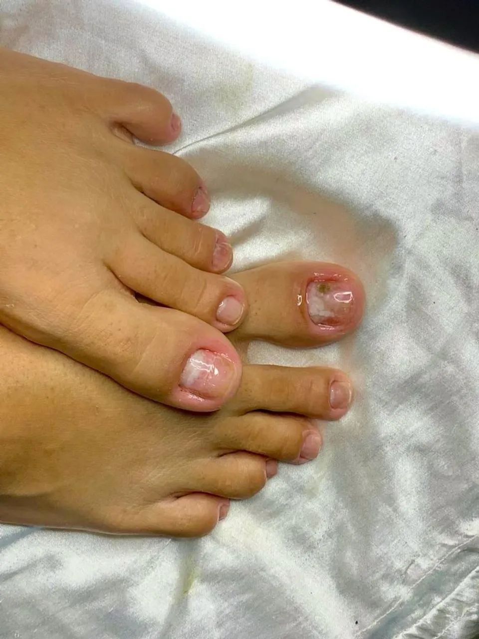 PEDICIRE+BLINDAGEM NAS UNHAS - Foto 3