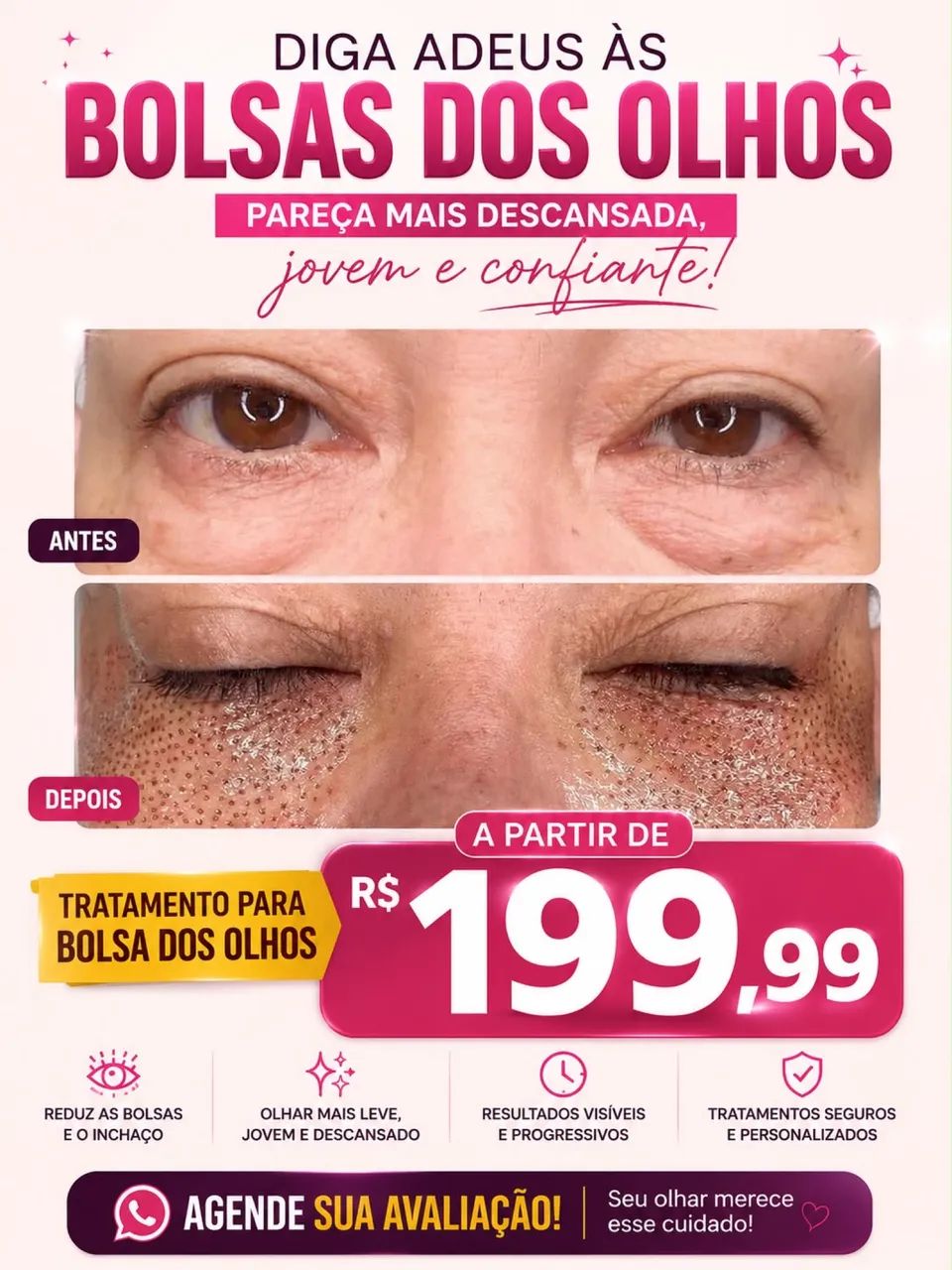 Jato de plasma facial  - Foto 2