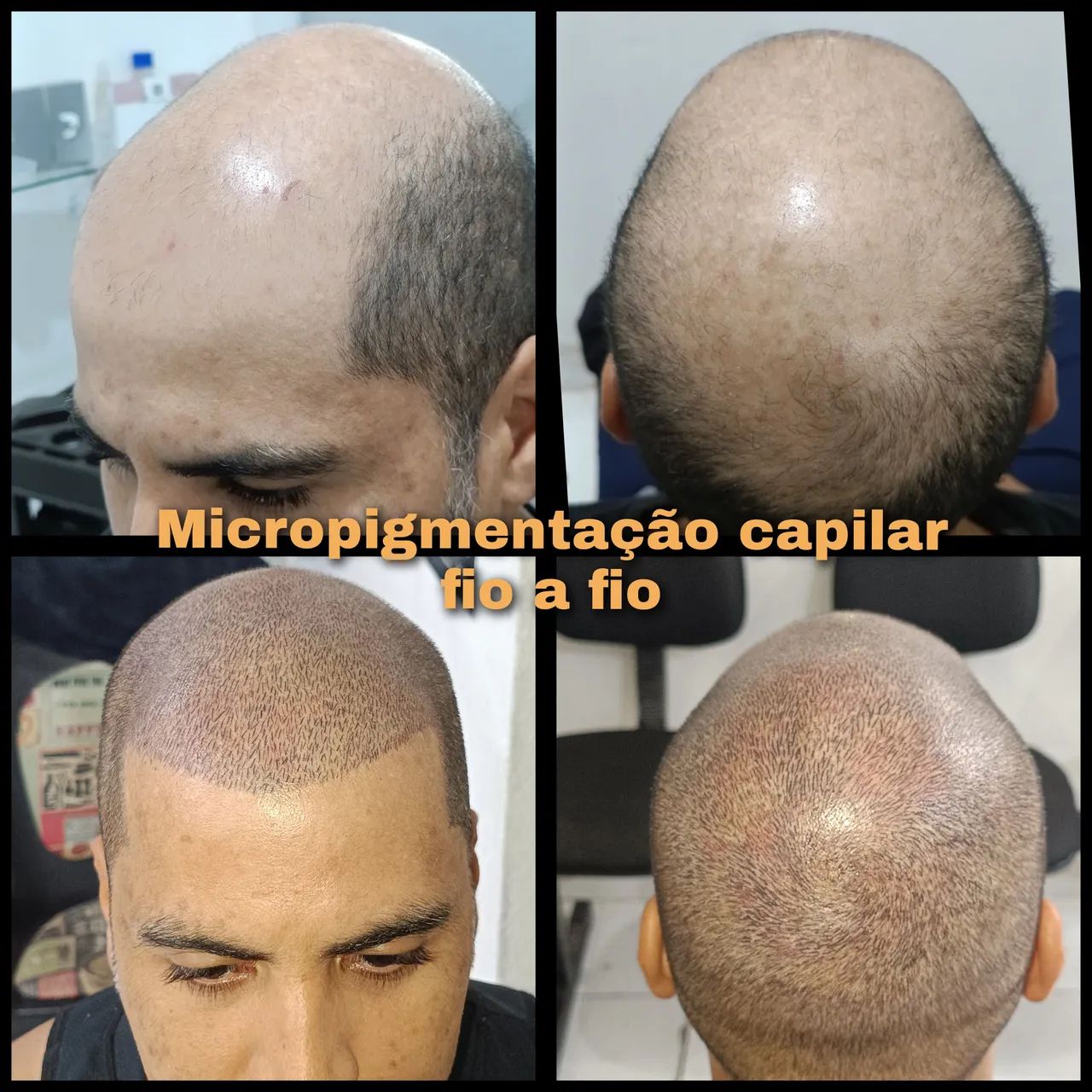 Micropigmentação capilar fio a fio 