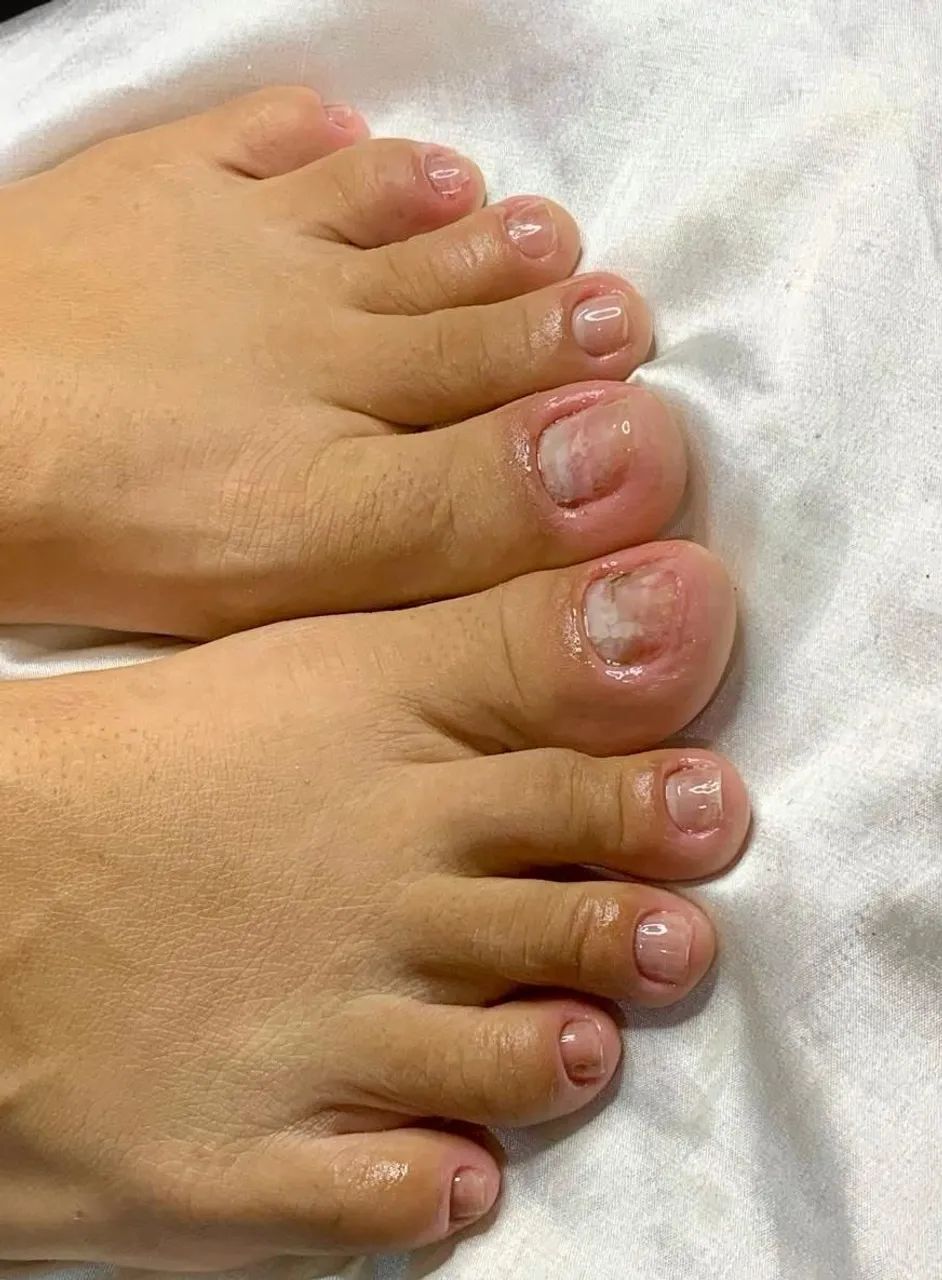 PEDICIRE+BLINDAGEM NAS UNHAS - Foto 4