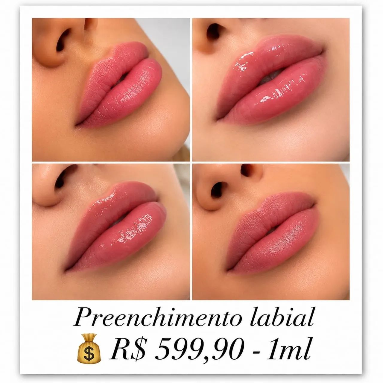 Estética Avançada - Botox, preenchimento labial e outros procedimentos. - Foto 2