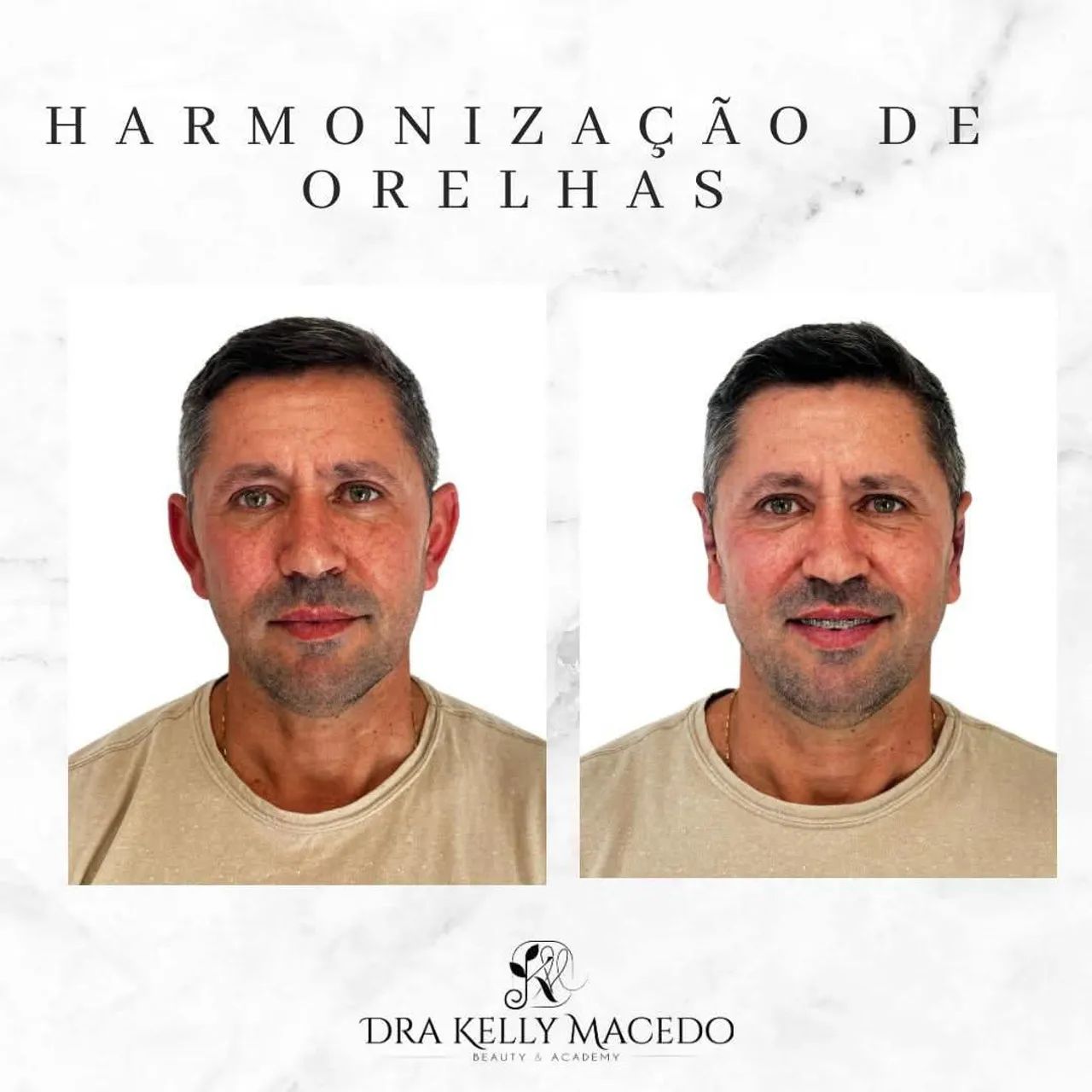 Harmonização de orelhas