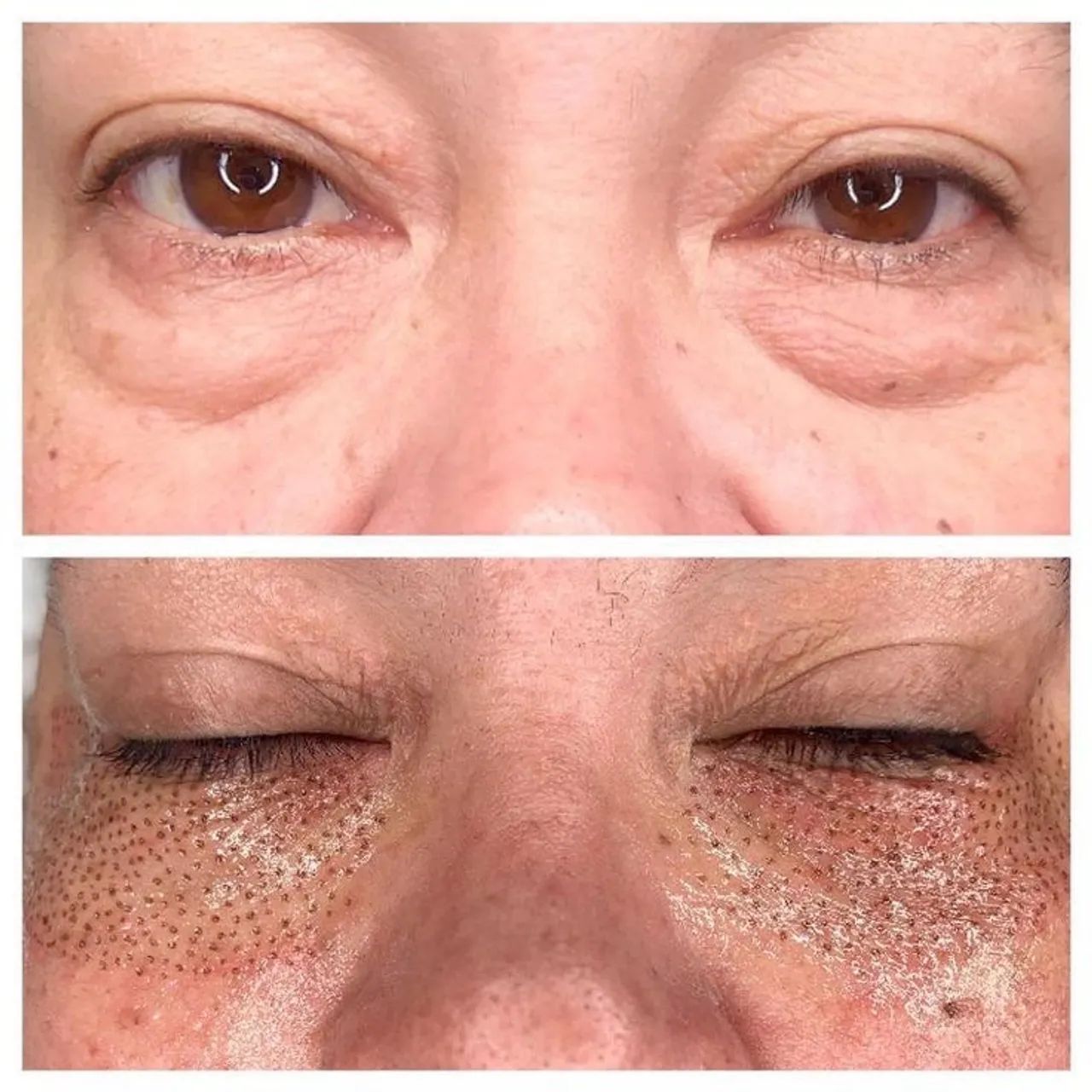 Jato de plasma facial  - Foto 3