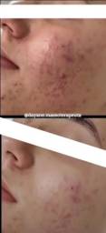 Título do anúncio: Kit de Tratamento 100% Natural para acne/espinhas 