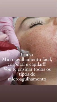 Curso de Microagulhamento Facial e Capilar