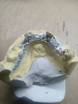Prótese Dentária Removivel 