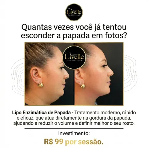 Tratamento para Papada - Lipo Enzimática - Tenha o contorno bem definido de seu pescoço.