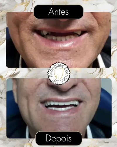Dentadura direto com protético 