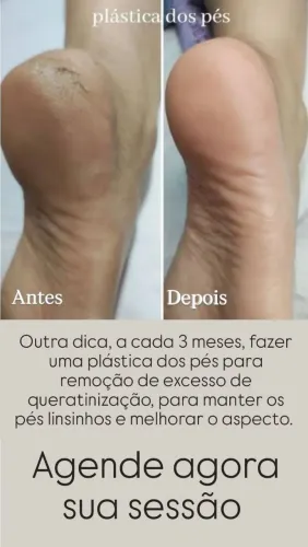 Plástica dos pés 