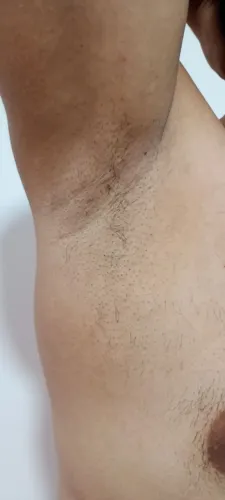 Depilação a Laser