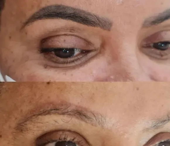 Remoção de micropigmentação 