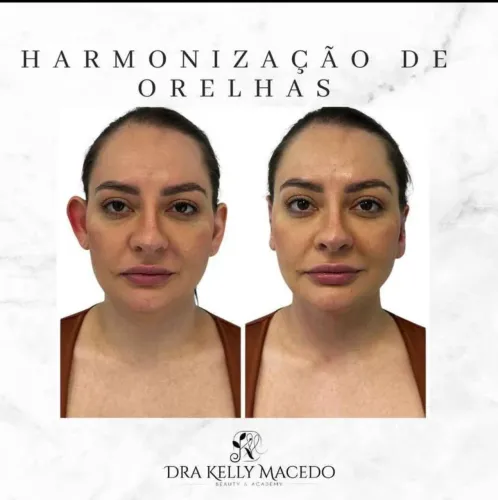 Harmonização de orelhas