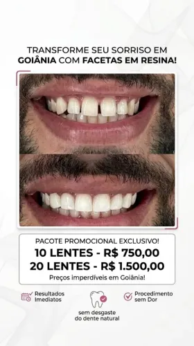 Facetas em Resina Premium