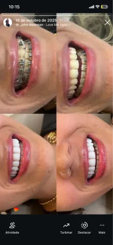 Facetas em resina 