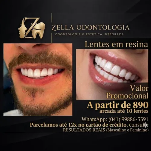 Facetas em resina em um valor super especial 
