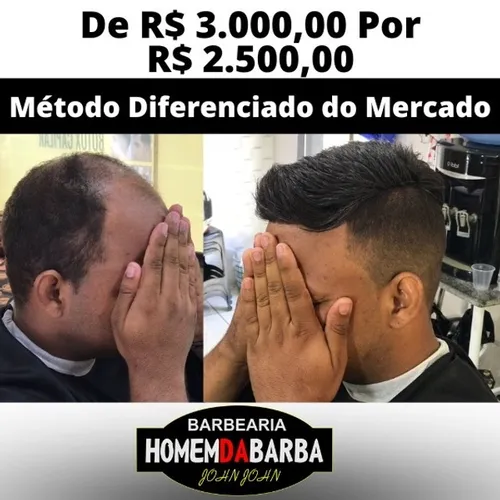 Prótese capilar em São Luís - Maranhão 