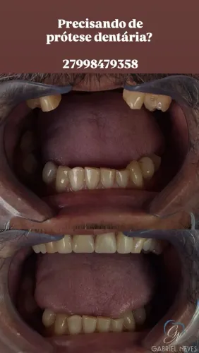 Prótese dentária/dentadura 