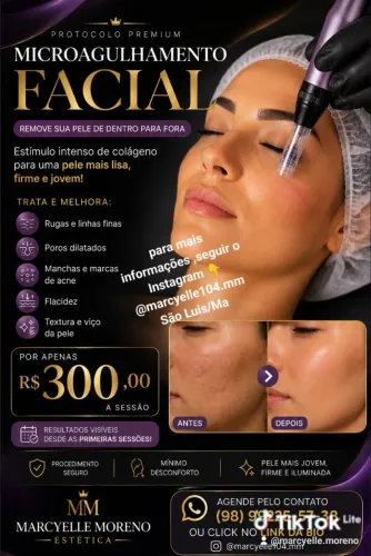 Microagulhamento