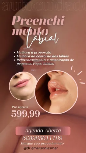 Preenchimento labial 