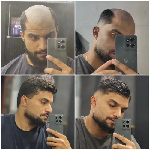 Prótese Capilar