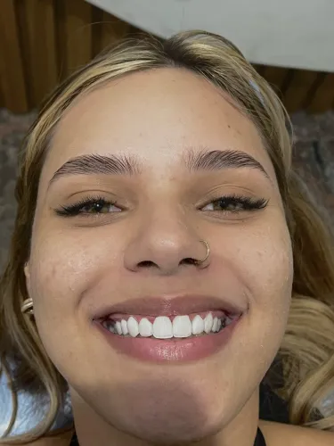 Facetas em resina