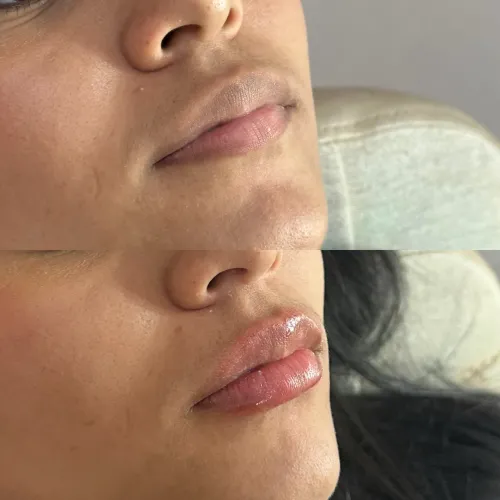 PREENCHIMENTO LABIAL