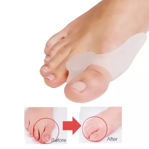 PROTETOR DE JOANETE EM SILICONE - CONFORTO IMEDIATO 1 PAR
