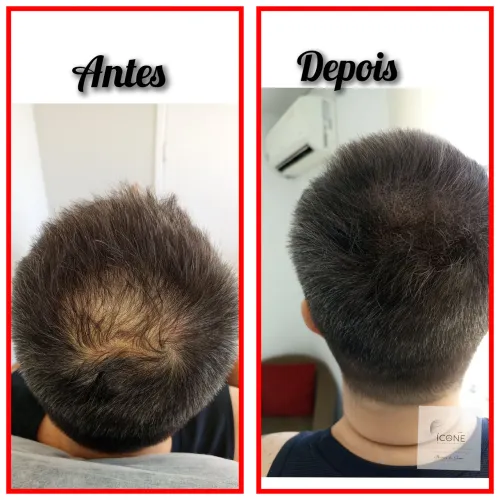 Fez Implante Capilar e Ficou com Falhas? Micropigmentação Natural