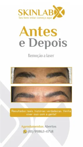 Remoção de tatuagem e micropigmentação a laser 