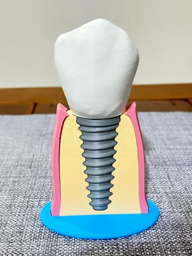Macromodelo implante