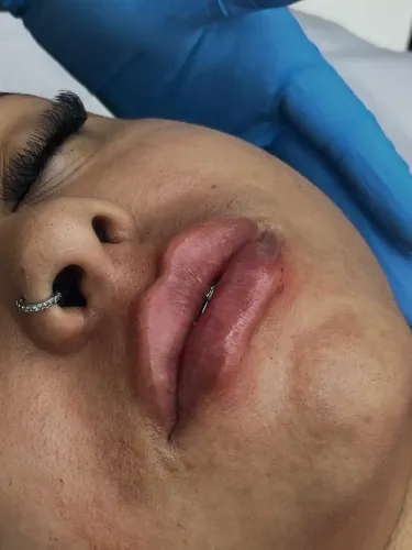 LIPSDAY | preenchimento labial a condição especial! 17/10