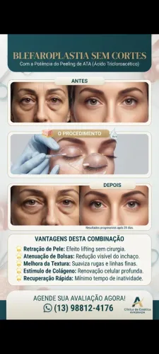 Blefaroplastia sem cortes com a potência do peeling ATA