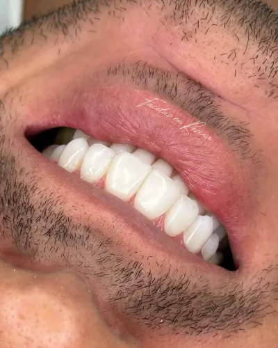 Facetas em Resina Estratificadas 