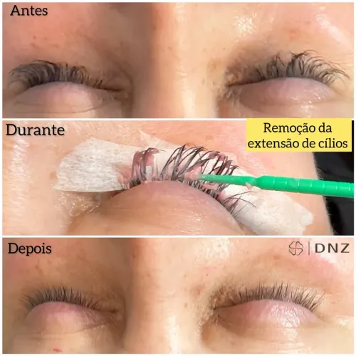 Remoção de extensão de cílios 