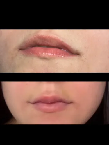 Harmonização facial 