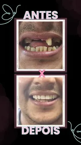 Prótese dentária (Dentadura)