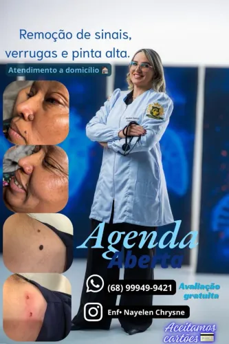 Remoção de verrugas e sinais.