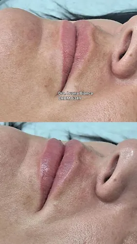 Preenchimento labial 
