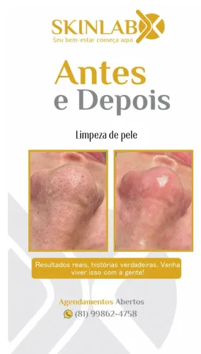 Limpeza de pele profunda 