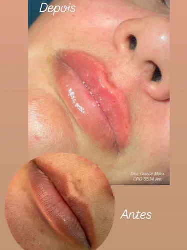 Preenchimento labial 