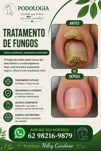 Podologia: Tratamento de Fungos 