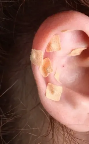 Auriculoterapia em Jacarepaguá.