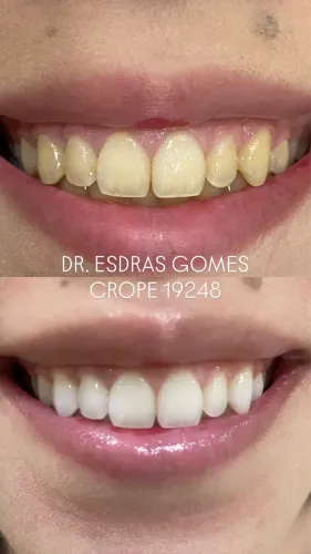 Clareamento Dental 
