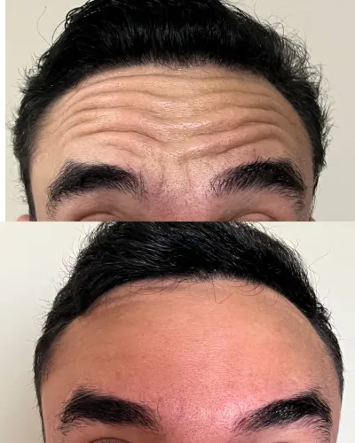 Botox